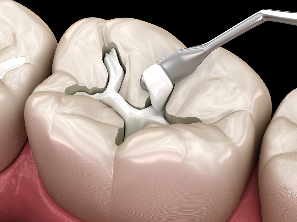 Composite Fillings in Nanaimo