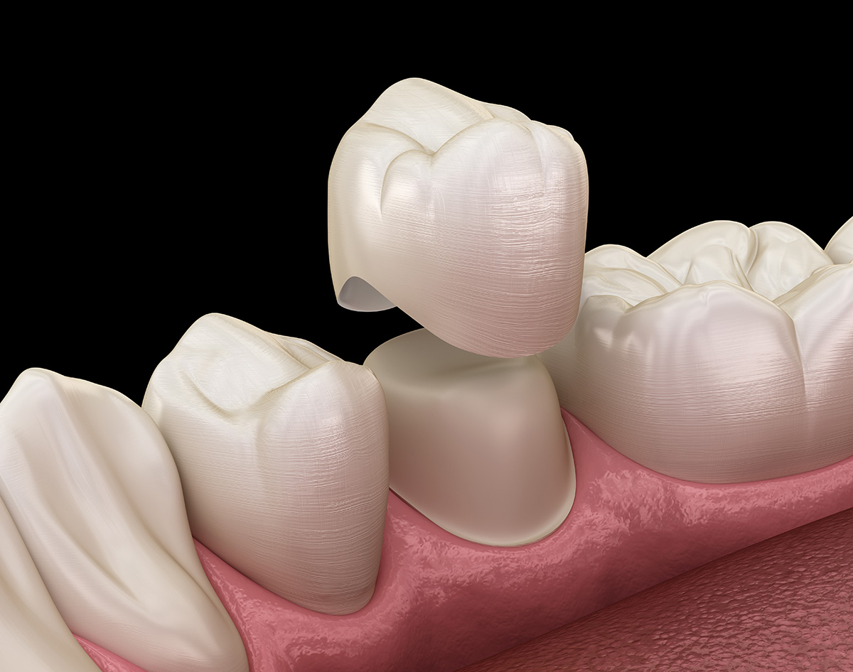 Dental Crowns in Nanaimo