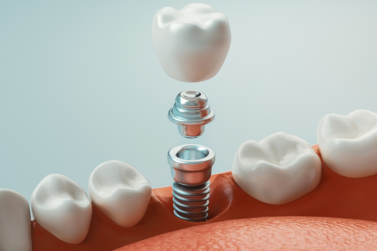Dental Implant Restorations Near You