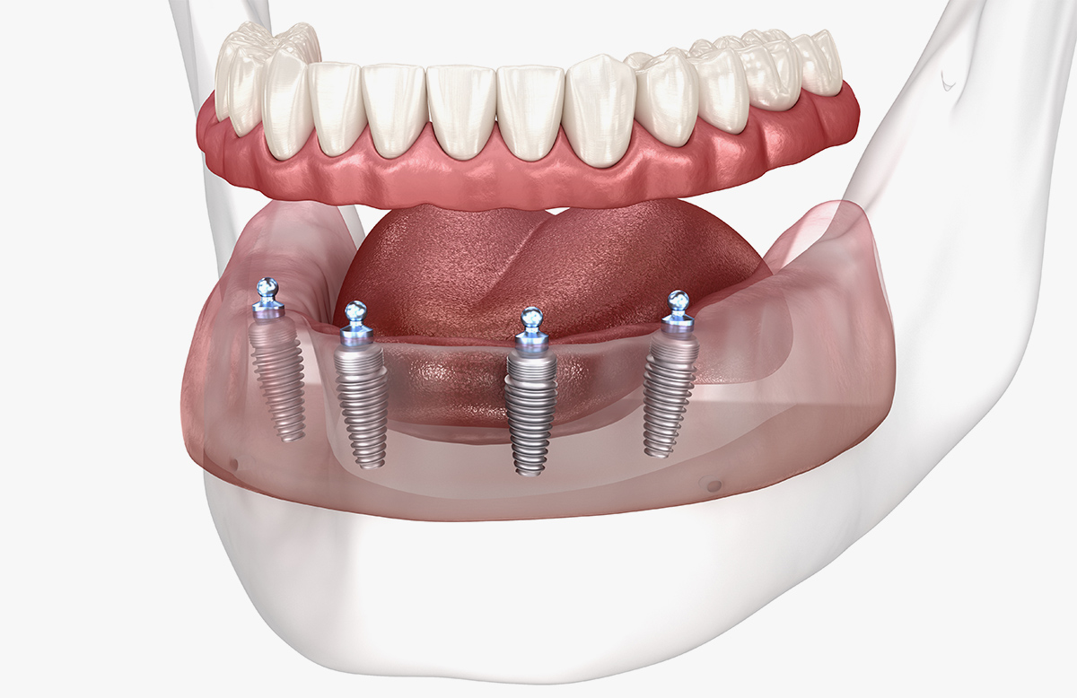 Full Arch Restorations in Nanaimo