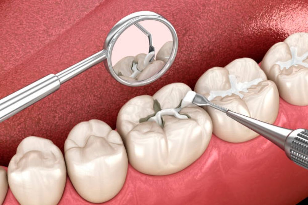 do-dental-sealants-hurt-or-feel-uncomfortable