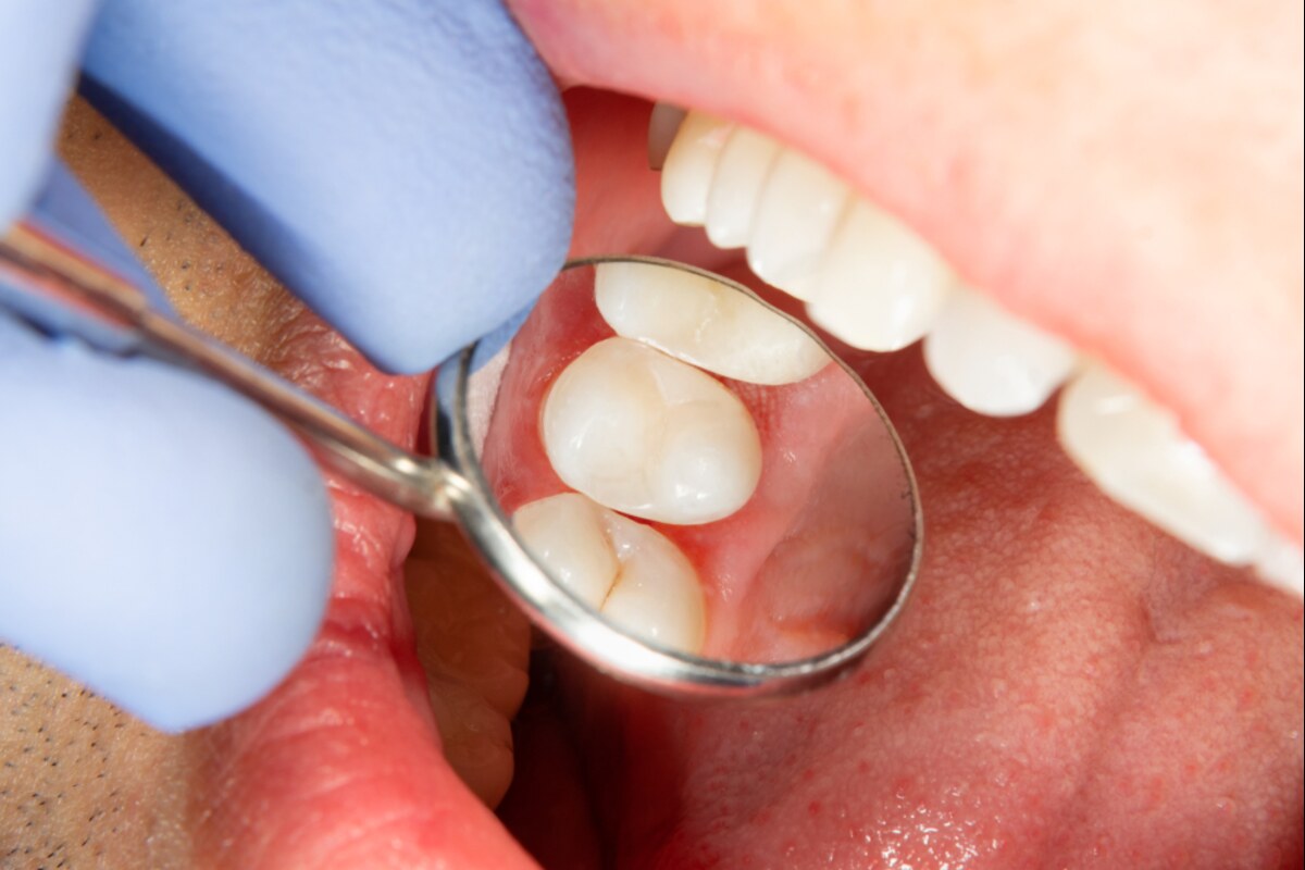 composite fillings in nanaimo