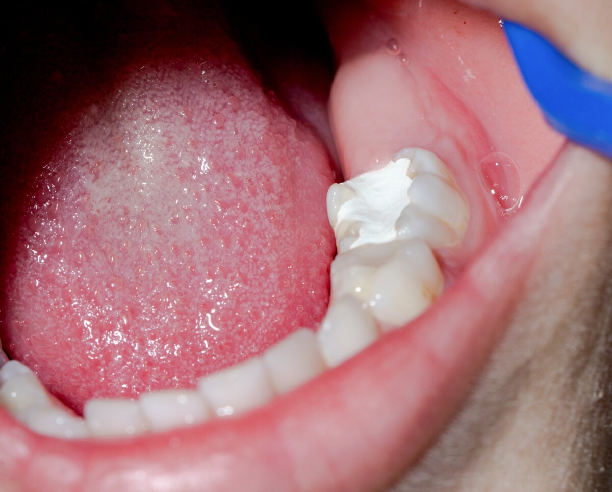 dental fillings in nanaimo