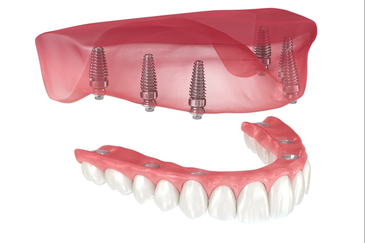 dental implant restorations in nanaimo