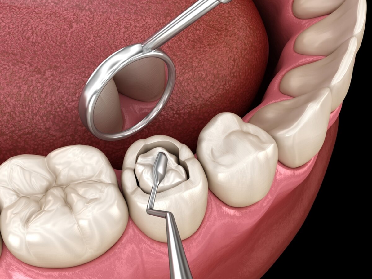 dental fillings in nanaimo