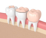 When Is a Dental Onlay Better Than a Crown?