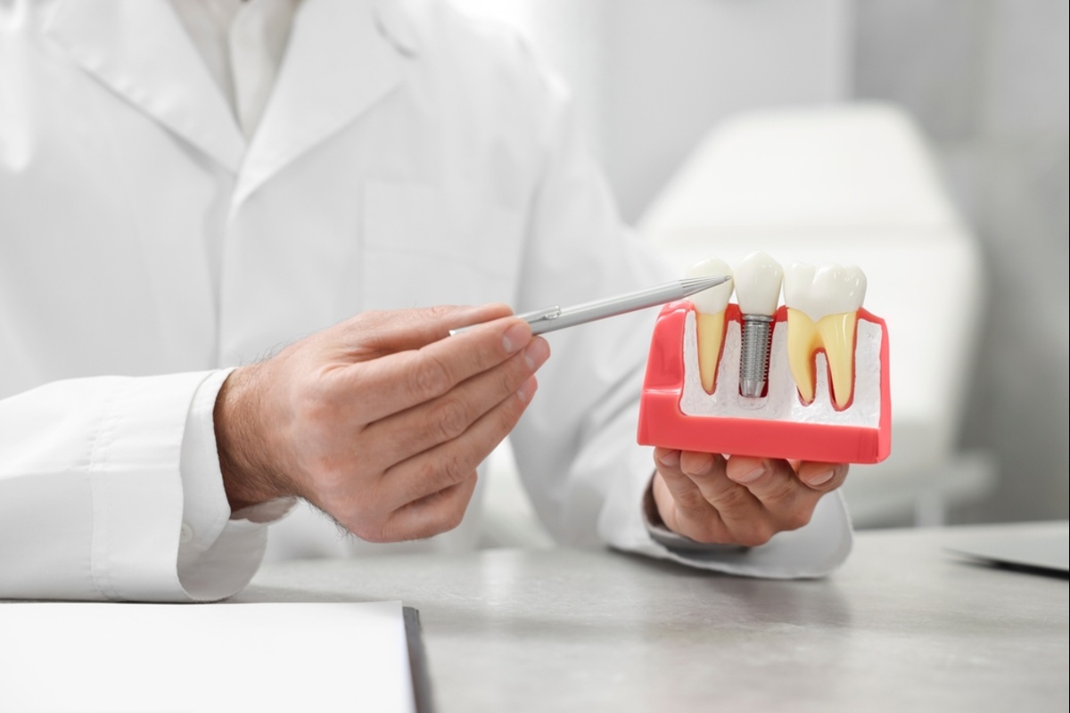 dental implants in nanaimo